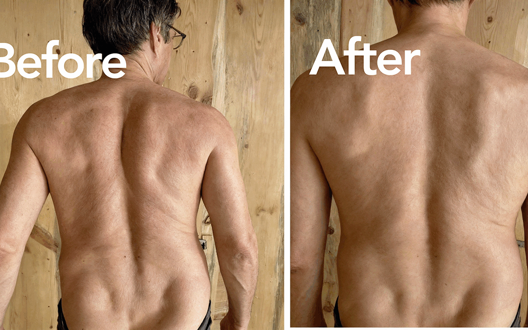 A sudden back collapse during a ski trip was reversed in minutes after one Fasciapuncture® session. See the before/after photos and understand the fascial mechanisms behind the change.