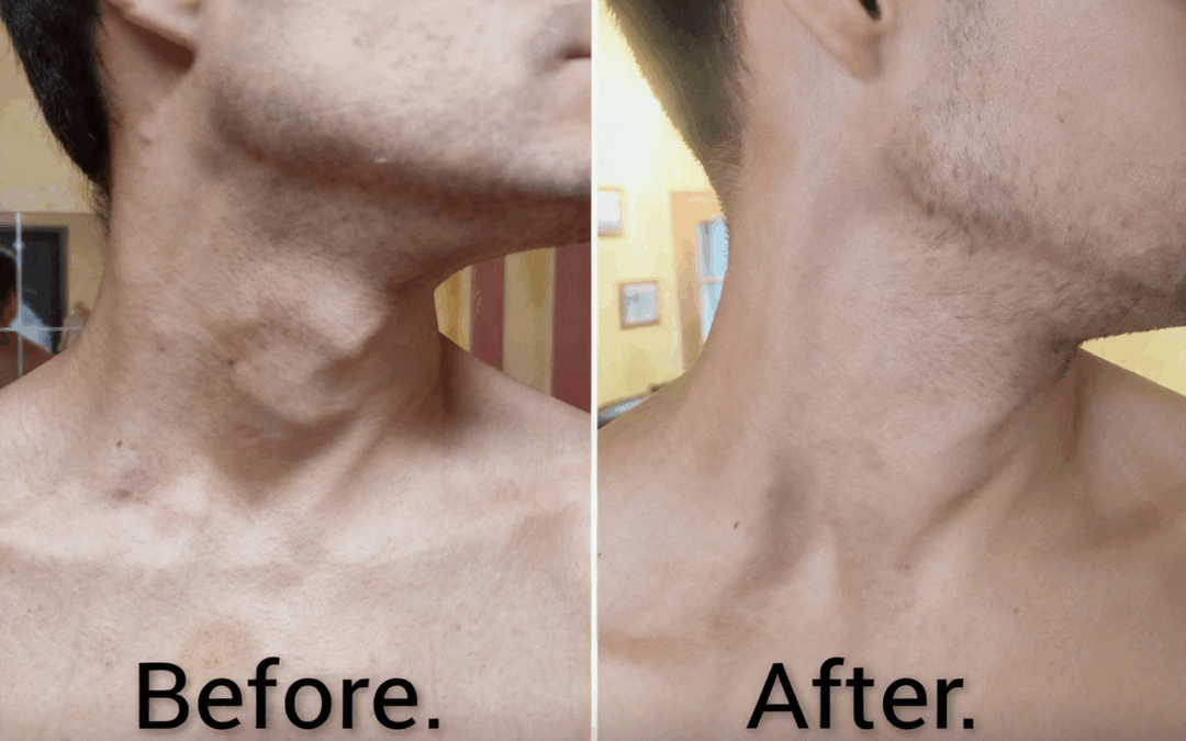 A Fascial Release Journey: From Congenital Neck Tension to Thyroid Balance