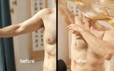 Immediate Restoration of Shoulder Elevation After One Fasciapuncture® Session