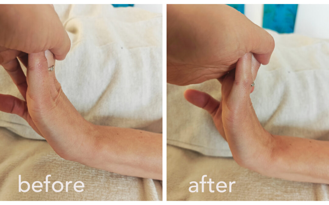 A Fascial Perspective on Hand Numbness, Coldness, and Mobility Loss