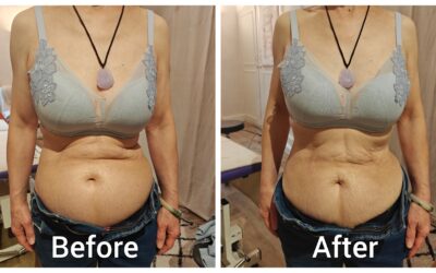 When the Abdomen Changes Without Weight Loss
